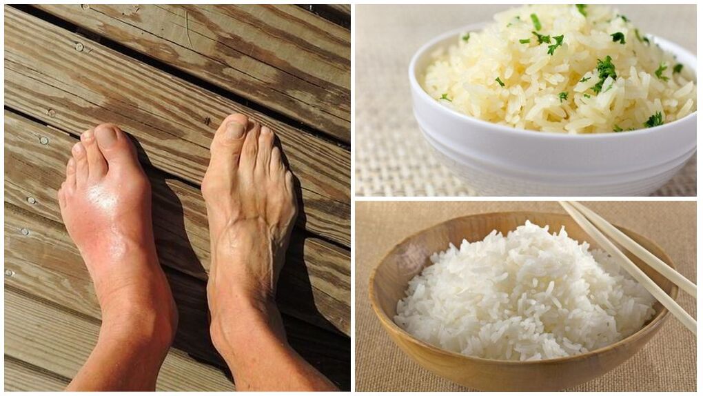 For patients with gout, a rice-based diet is recommended. 